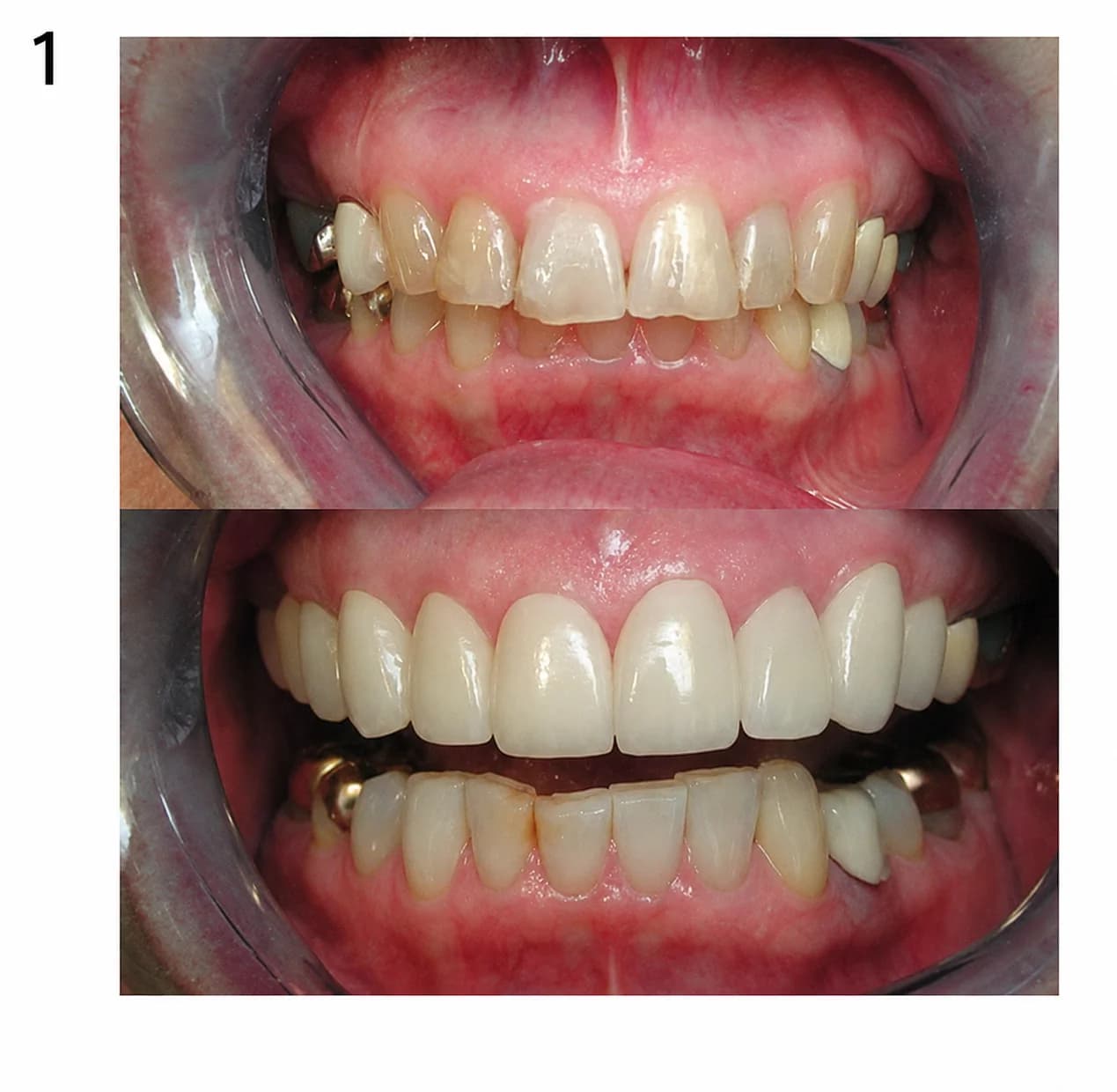 Before and after porcelain veneers by Dr. Andy Engel at Living Dental Health in Bend, Oregon — Case 01