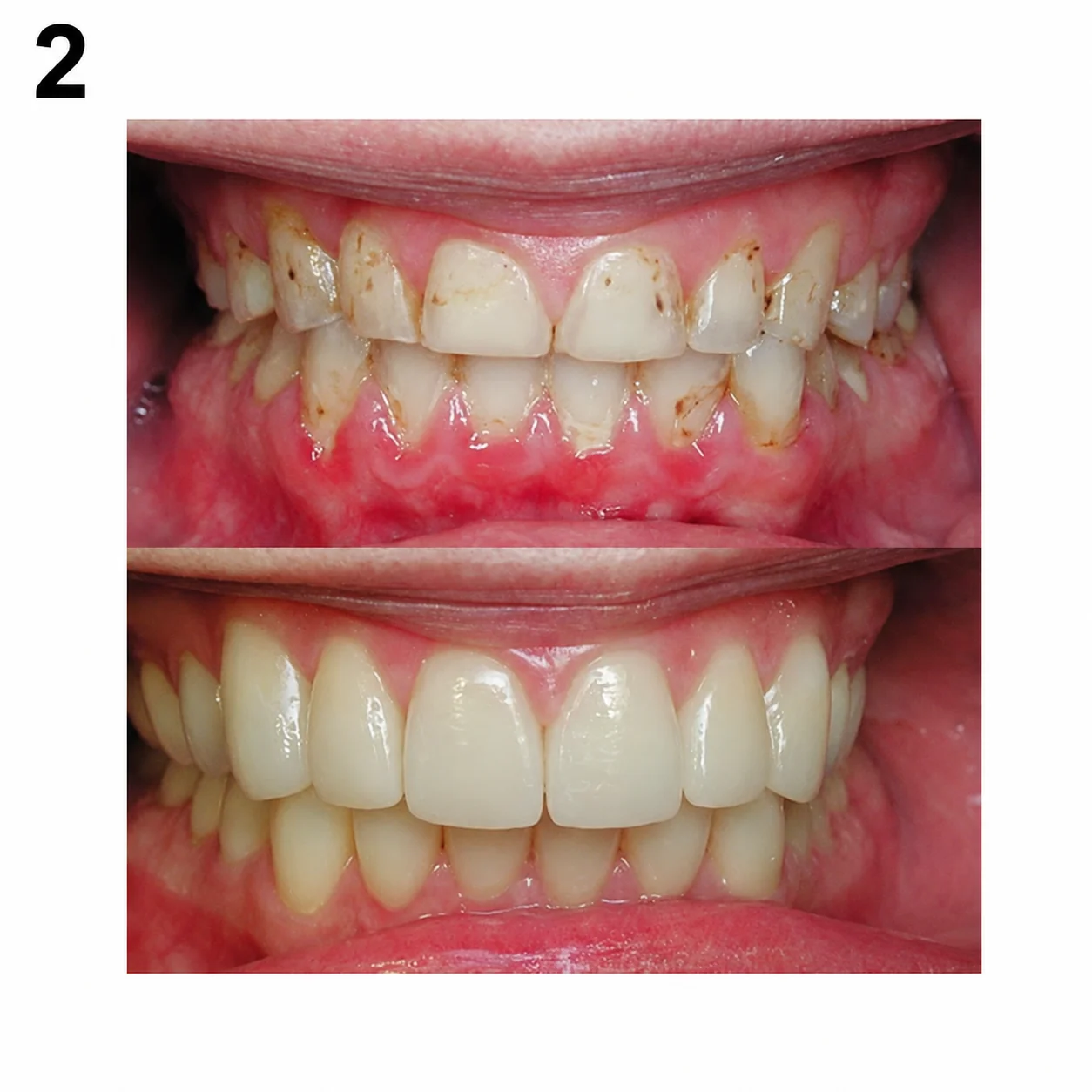Before and after full mouth reconstruction by Dr. Andy Engel at Living Dental Health in Bend, Oregon — Case 02