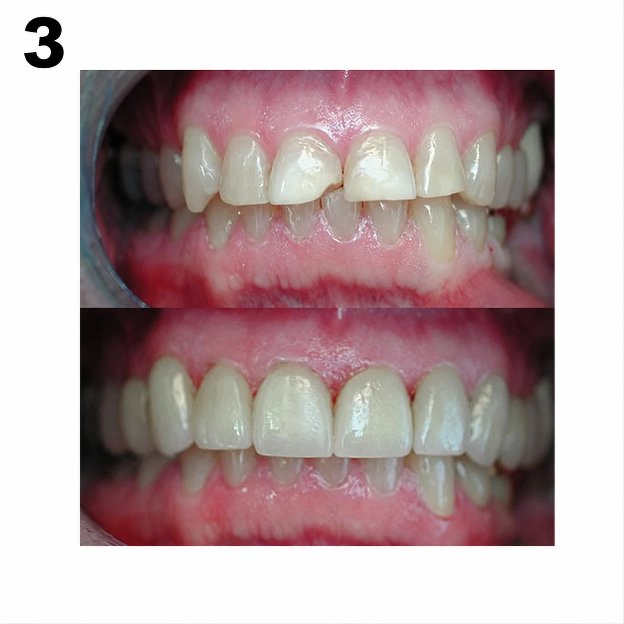 Before and after porcelain crowns by Dr. Andy Engel at Living Dental Health in Bend, Oregon — Case 03