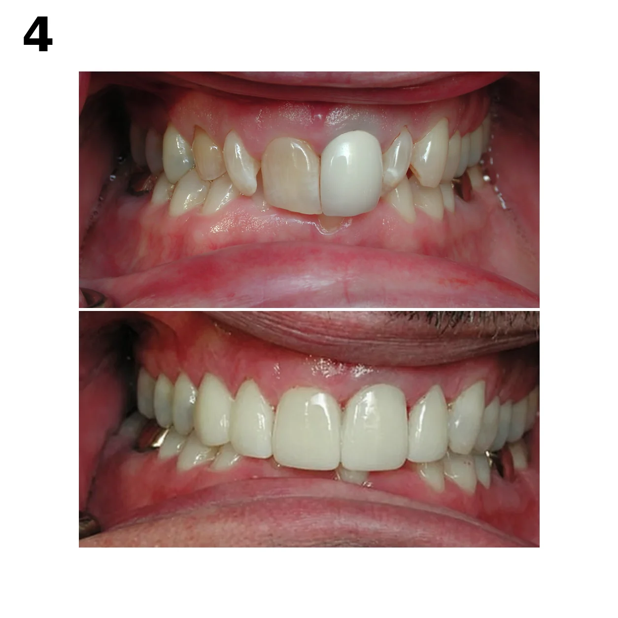 Before and after porcelain crowns by Dr. Andy Engel at Living Dental Health in Bend, Oregon — Case 04