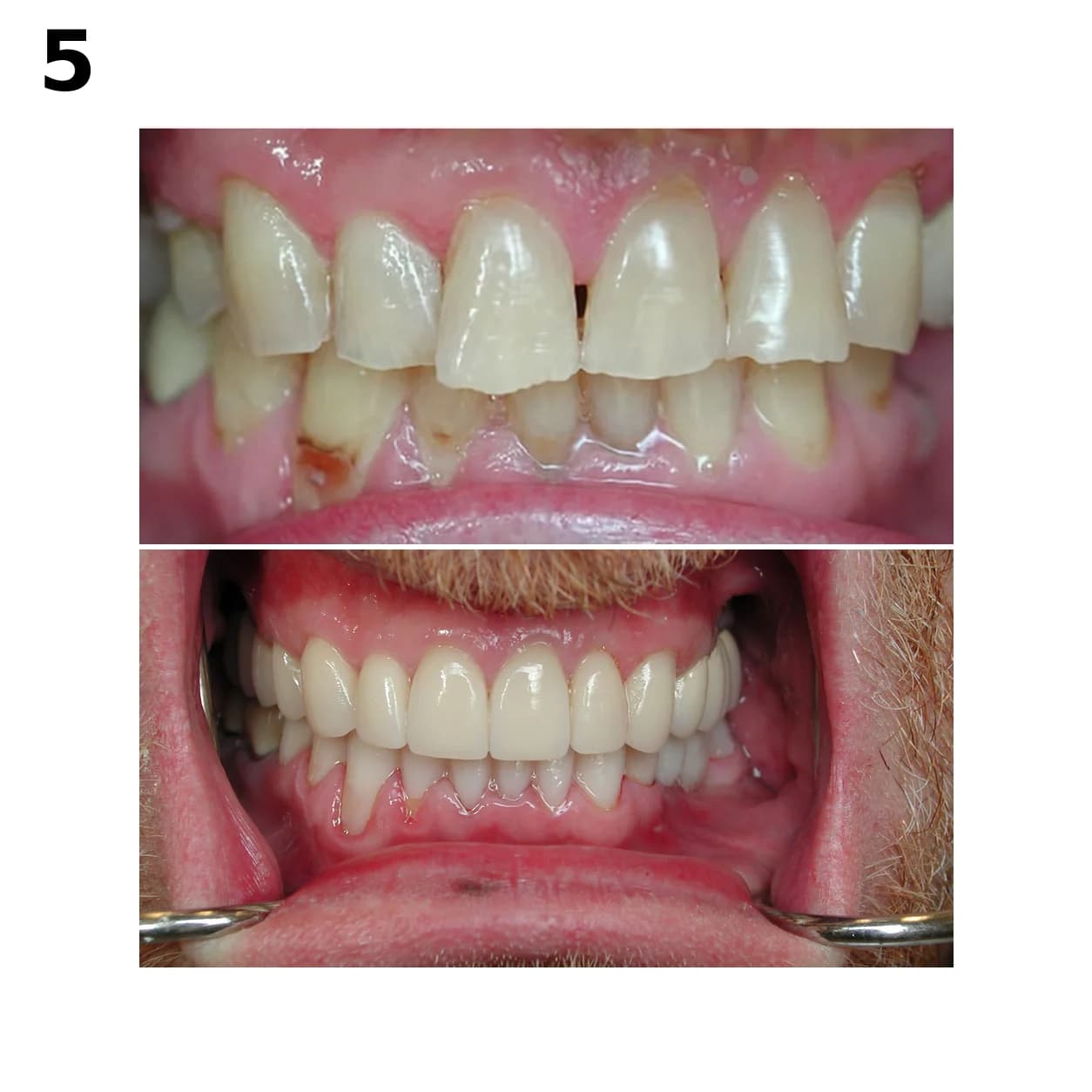 Before and after full mouth reconstruction by Dr. Andy Engel at Living Dental Health in Bend, Oregon — Case 05
