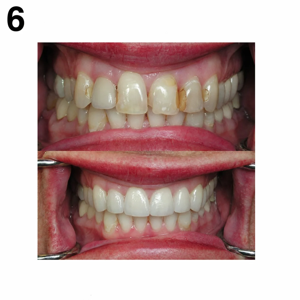 Before and after crowns and veneers by Dr. Andy Engel at Living Dental Health in Bend, Oregon — Case 06