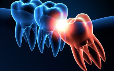 Some Wise Advice on Wisdom Teeth Removal